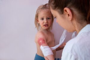 pediatric burn management
