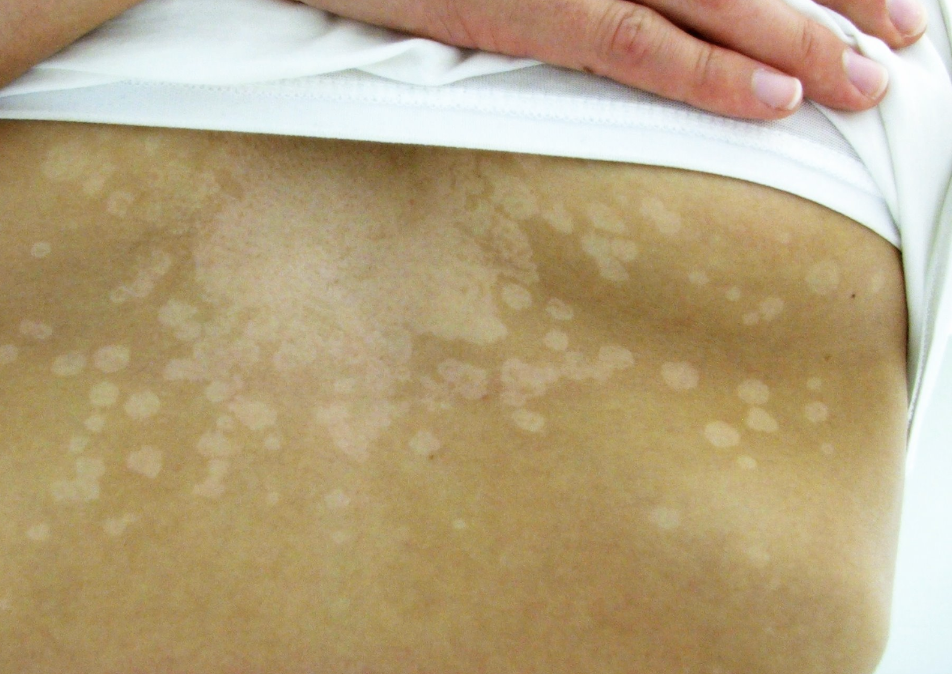 Understanding Skin Conditions: Pityriasis Rosea vs. Tinea Versicolor ...